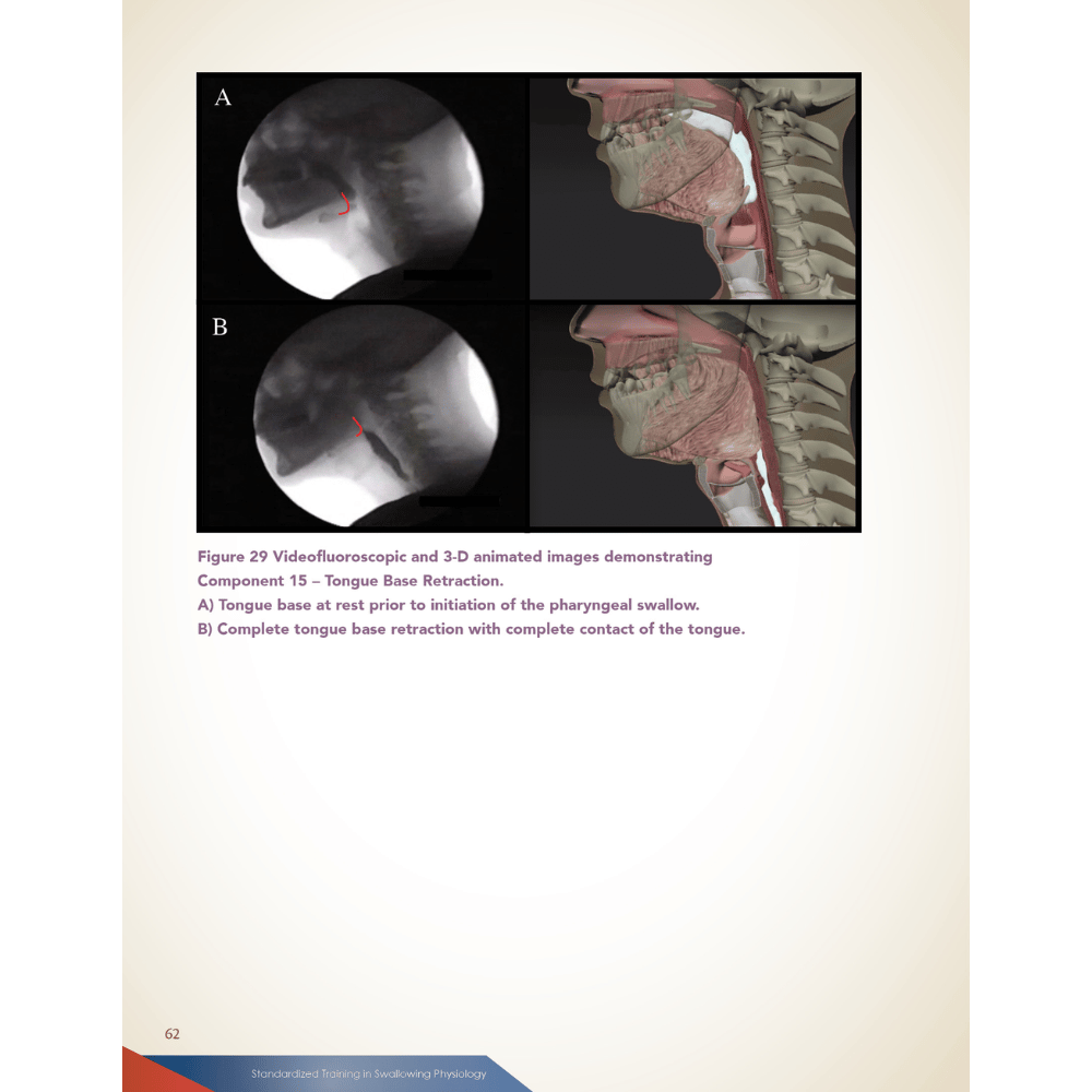 MBSImP: Modified Barium Swallow Impairment Profile Approach